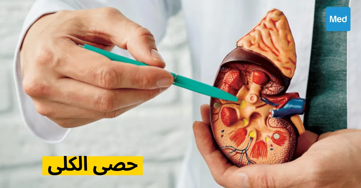 حصى الكلى: الأسباب والأعراض والعلاج